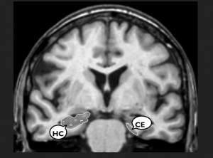 Coupe frontale de cerveau humain. HC = hippocampe; CE = cortex entorhinal.