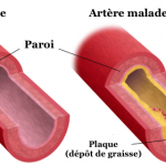 artere-carotide