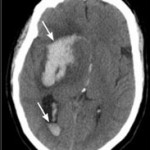 AVC-neuroimagerie