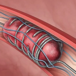 catheter avc