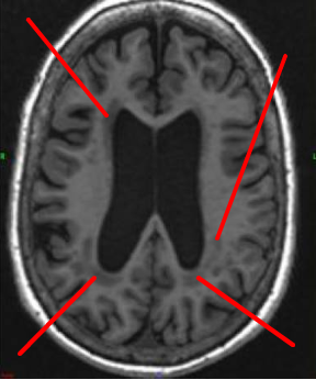 Leucopathie - Neuromedia