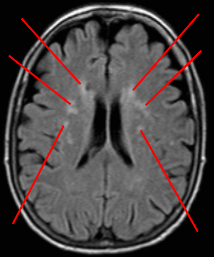 Leucopathie - Neuromedia