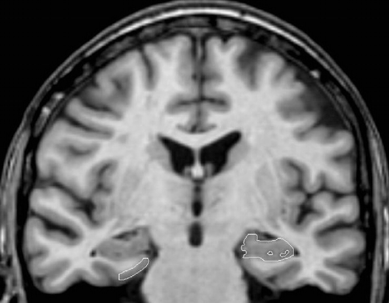 IRM-Alzheimer - Neuromedia