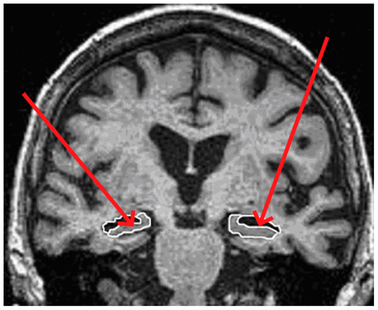 Imagerie par résonance magnétique (IRM) cérébrale Neuromedia