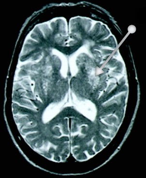 Accident vasculaire cérébral - Neuromedia