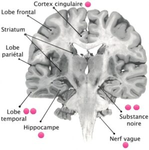 D mence Corps De Lewy Neuromedia