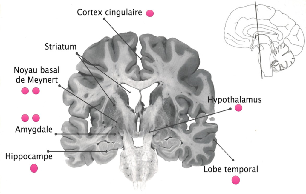 D mence Corps De Lewy Neuromedia